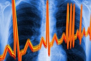 Širdies ritmo pokyčiai ir sutrikimai - gimdos kaklelio osteochondrozės požymis